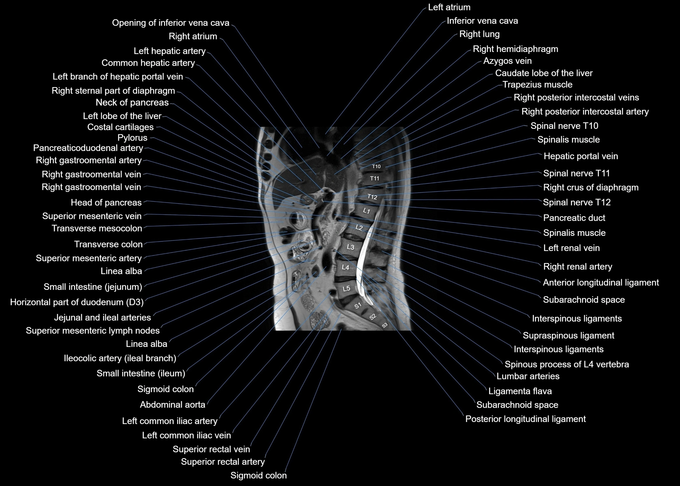 MRI abdomen sagittal cross sectional anatomy  radiology  image-img-00001-00036.webp